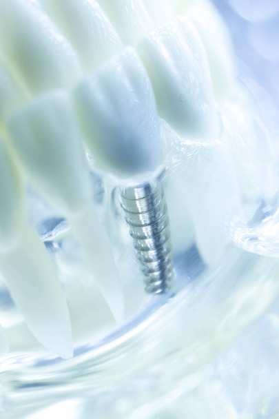 Dental titanium tooth implant - Photo, Image