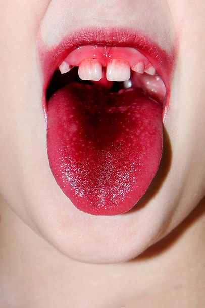 La bouche d'un enfant avec la langue arrachée de couleur bordeaux et sans une dent avant. Au-dessus de la lèvre supérieure se trouvent également des traces de boisson bourgogne
 - Photo, image