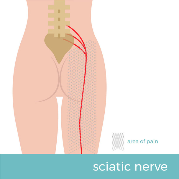 Ανατομία του ισχιακού νεύρου. εικόνα που δείχνει η σχηματική πορεία του νεύρου και ο τόπος όπου ο πόνος προκύπτει. ισχιαλγία  - Διάνυσμα, εικόνα