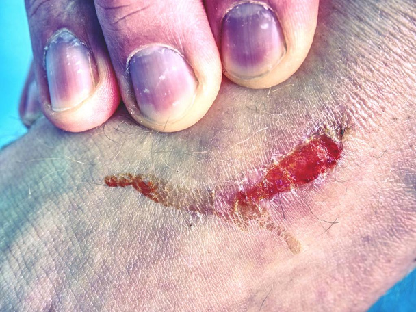 Ensiapu verinen haava jalka punaisella paikalla kipeä alue. Urheiluvammojen ja terveydenhuollon käsite. Haava jalassa kuivalla verellä
 - Valokuva, kuva