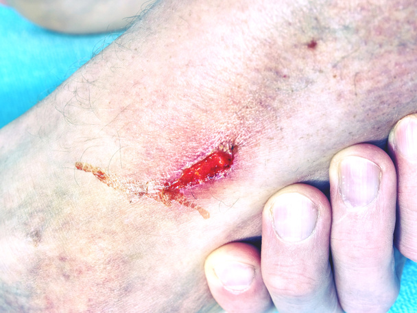 Λεπτομέρεια από ένα φρέσκο ψώρα στο πόδι μετά από ατύχημα του αθλητισμού. Υγρό αιματηρή τριβή στο δέρμα κάτω από το γόνατο ενός ασθενούς σπορ. - Φωτογραφία, εικόνα