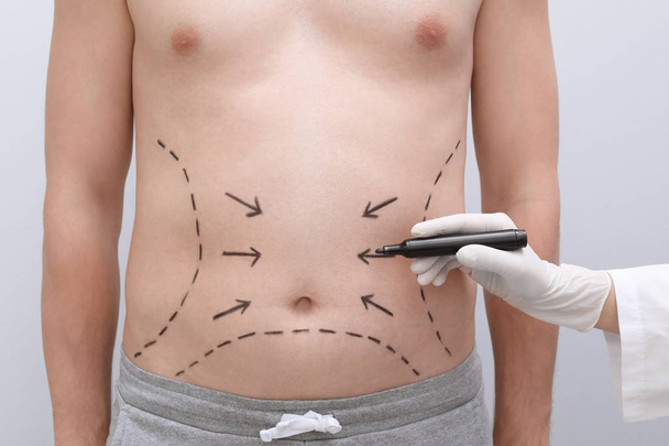 Doctor drawing lines on man's stomach with marker against light background - Valokuva, kuva