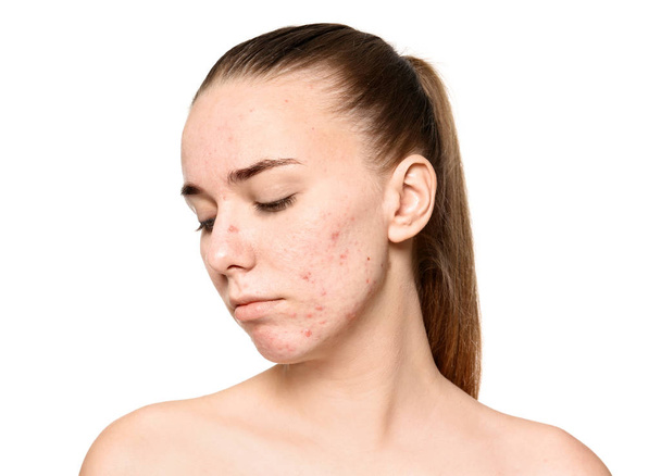 Young woman with acne problem on white background - Foto, Imagen
