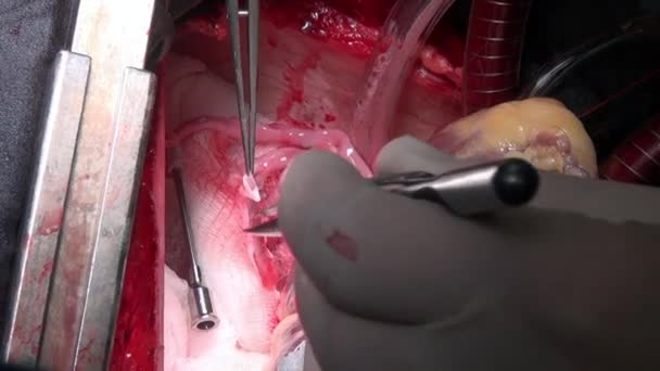 Hart chirurgie unieke macro video close-up in kliniek. - Video