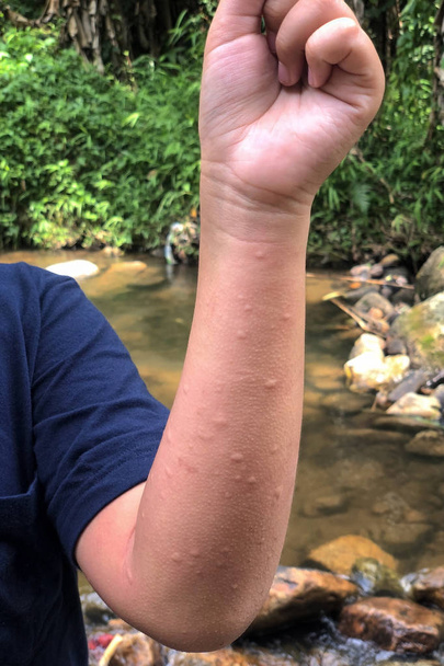 Psoriasis on young boy hand with macular eruption, rash and patches on skin. Allergy from insect, plant, or flower during travel at waterfall and forest. - Photo, Image