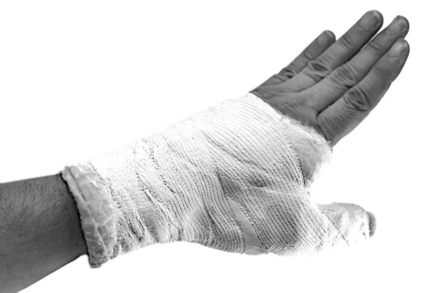Рука со сломанным большим пальцем и белым гипсом, чтобы обездвижить сломанную конечность во время дорожно-транспортного происшествия с черно-белым effct
 - Фото, изображение
