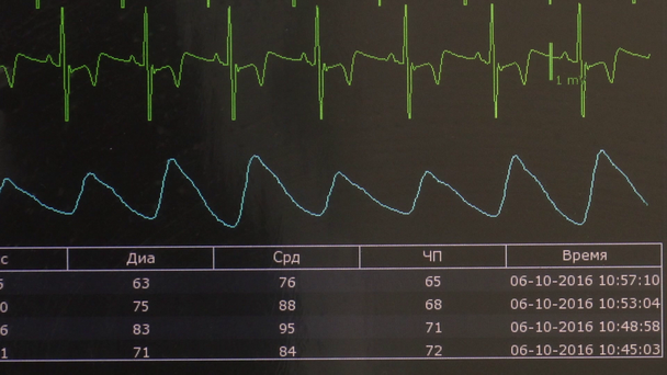 Cardiograma de ritmo de coração e imagem de pulso no monitor durante a operação
. - Filmagem, Vídeo