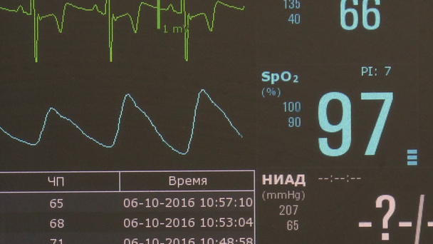 Καρδιογράφημα ρυθμό της καρδιάς και παλμό εικόνα στην οθόνη κατά τη διάρκεια λειτουργίας. - Πλάνα, βίντεο