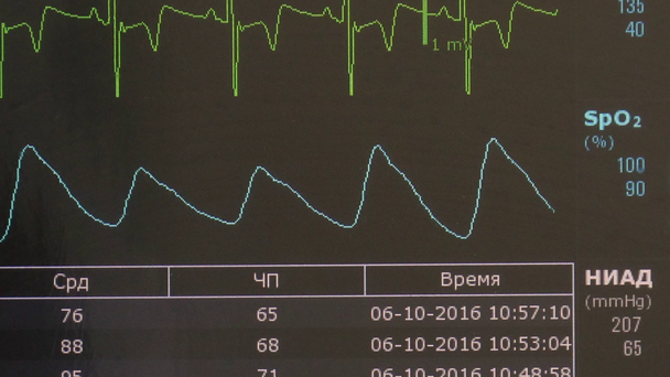 Kardiogramm des Herzrhythmus und des Pulses während der Operation auf dem Monitor. - Filmmaterial, Video