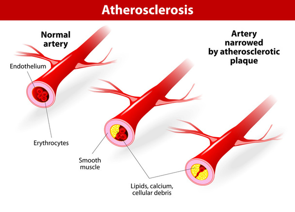 Illustra la progressione dell'aterosclerosi nei pazienti con CVD
. - Vettoriali, immagini