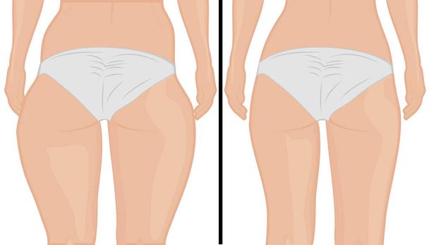 Korekcja thigs tłuszczu. Liposukcja. Przed i po. Ilustracja wektorowa korekty ciała kobiety - Wektor, obraz
