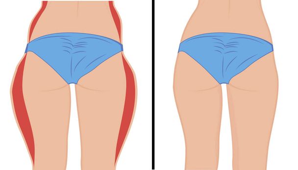 Şişman thigs düzeltme. Liposuction. Önce ve sonra. Kadın vücut düzeltme vektör çizim - Vektör, Görsel