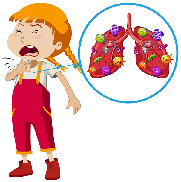 ein Vektor der Lungeninfektion eines Mädchens Illustration - Vektor, Bild