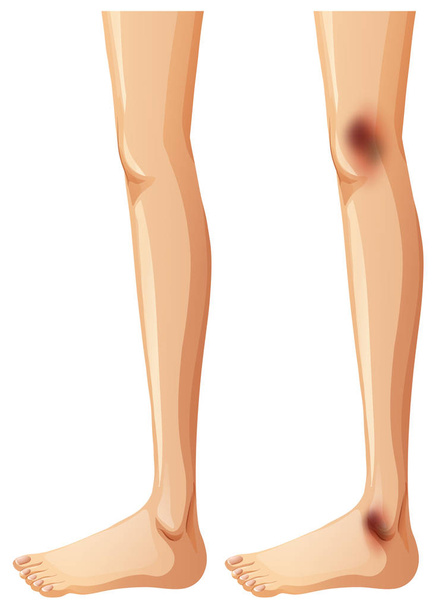 menschliche Beine und Blutergüsse auf weißem Hintergrund - Vektor, Bild