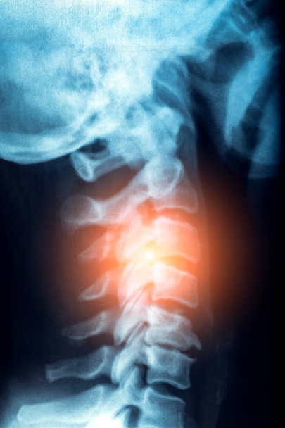 Рентген или МРТ шеи человека с красной зоной боли и стресса в позвоночнике или позвоночнике, травмы и ревматизм
 - Фото, изображение