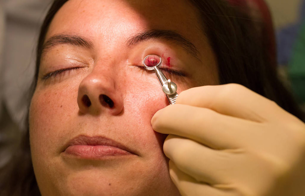 Concepto de salud - Chalazion durante el examen y la operación ocular - Femenino
 - Foto, Imagen