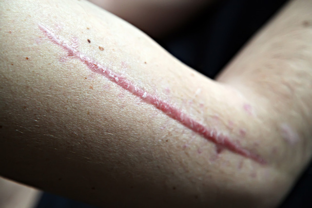 cicatriz na pele humana
 - Foto, Imagem