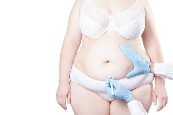 Lääkäri merkitsee paksun naisen vatsan plastiikkakirurgiaan. Painonpudotus käsite. (eristetty valkoisella taustalla
) - Valokuva, kuva