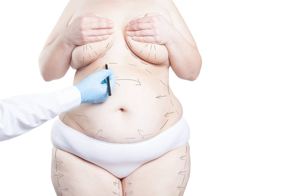 Arzt markiert dicken Frauenbauch für plastische Chirurgie. Gewichtsverlust Konzept. (isoliert auf weißem Hintergrund) - Foto, Bild