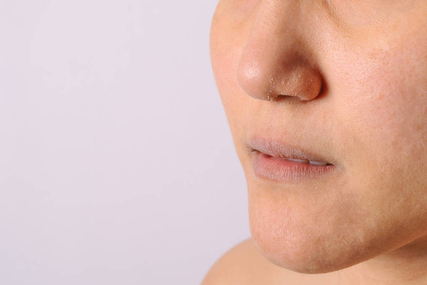 Алергічні жінки мають екзему сухий ніс і губи в зимовий сезон крупним планом
. - Фото, зображення