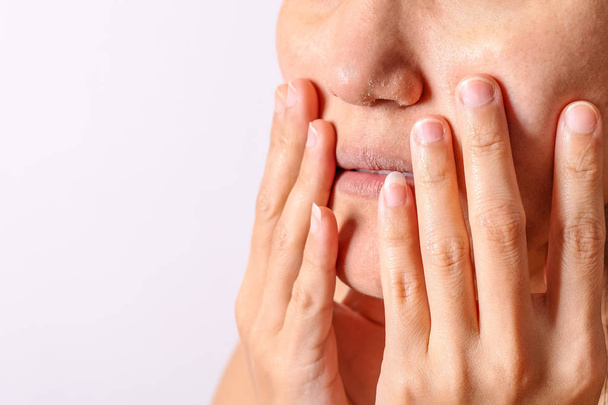 Allergic women have eczema dry nose and lips on winter season closeup. - Foto, Imagen