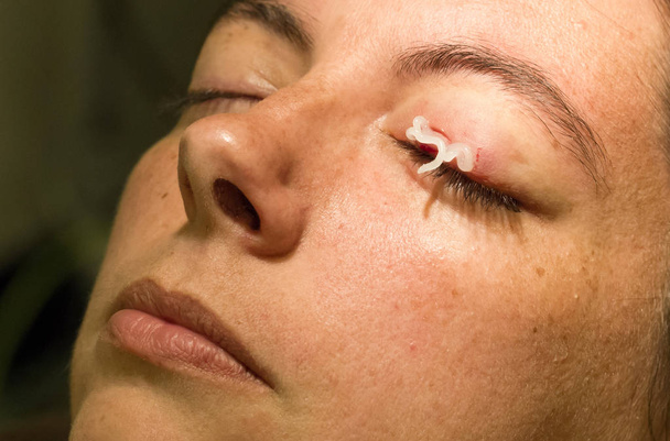 Healthcare concept - Medicine on eye - Chalazion during eye examination and operation - Female - Photo, Image