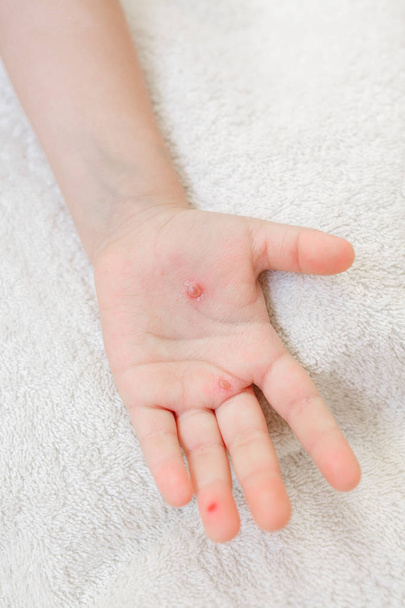 La main d'un enfant atteint de varicelle. Plaquettes thermoformées sur la main à partir de la varicelle
 - Photo, image