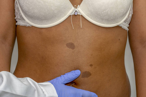Молода африканка з відміткою про народження на шкірі спини. Перевірка доброякісних моль
 - Фото, зображення
