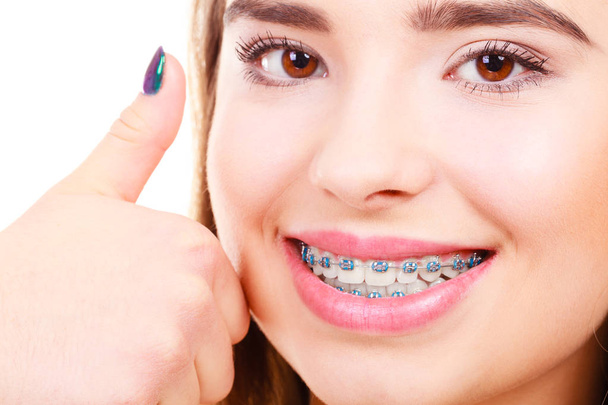 Концепция дантиста и ортодонта. Женщина улыбается показывая свои белые зубы с голубыми брекетами, большой палец вверх жестом
. - Фото, изображение