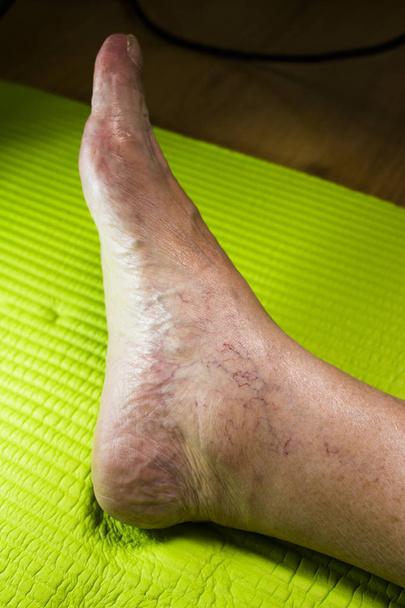 Closeup of varicose veins on the ankle of a woman over 80 years - Photo, Image