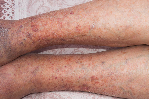 Close-up of skin with varicose veins - Photo, Image