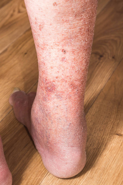 Close-up of skin with varicose veins - Photo, Image