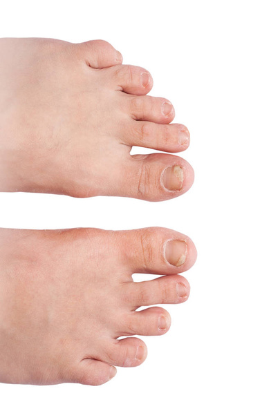 infeção fúngica das unhas (onicomicose). pele grossa seca das pernas (eczema
) - Foto, Imagem