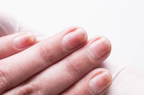 Onycholysis geïsoleerd op een witte achtergrond. Mechanische beschadiging van de nagelplaat. Schade aan de nagel na het toepassen van schellak of gel-lak (Gel-lak). - Foto, afbeelding