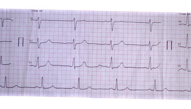 Skutečné páska s kardiogram člověka. Obrázek z elektrokardiogramu close-up. - Fotografie, Obrázek