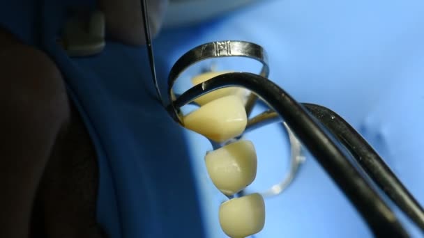 Dentista que trata los dientes de un paciente con herramientas dentales en la clínica dental. Vista de cerca de los dientes en la cabaña dental
. - Imágenes, Vídeo