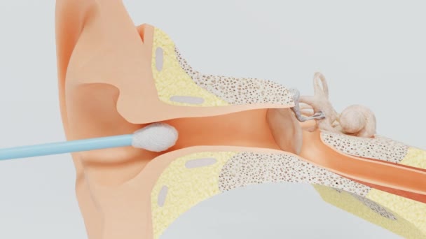 Inaccurate movement of cotton swab tears the eardrum. Hearing loss due the hearing membrane rupture. - Footage, Video