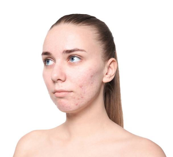 Young woman with acne problem on white background - Fotó, kép