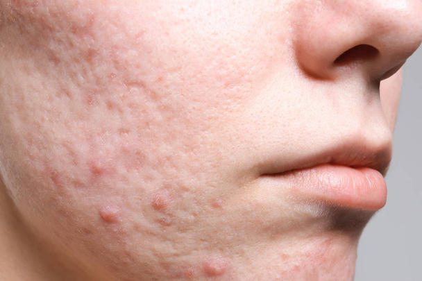 Young woman with acne on her face, closeup - Foto, afbeelding