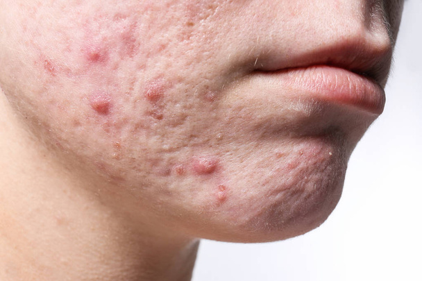 Young woman with acne on her face, closeup - Foto, imagen