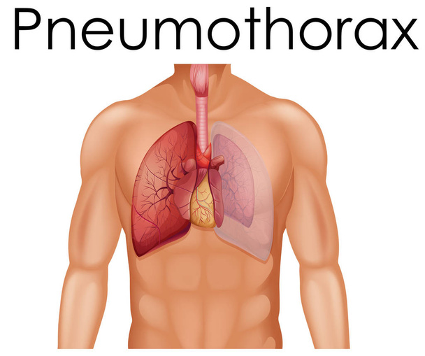 Une anatomie humaine du pneumothorax illustration
 - Vecteur, image