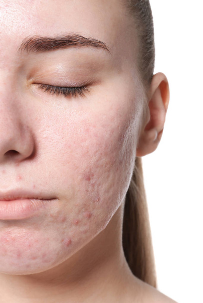 Young woman with acne problem on white background - Fotoğraf, Görsel