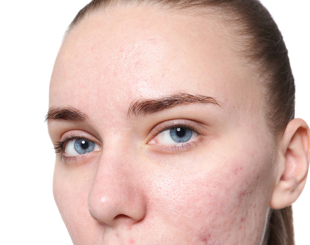 Young woman with acne problem on white background - Fotografie, Obrázek