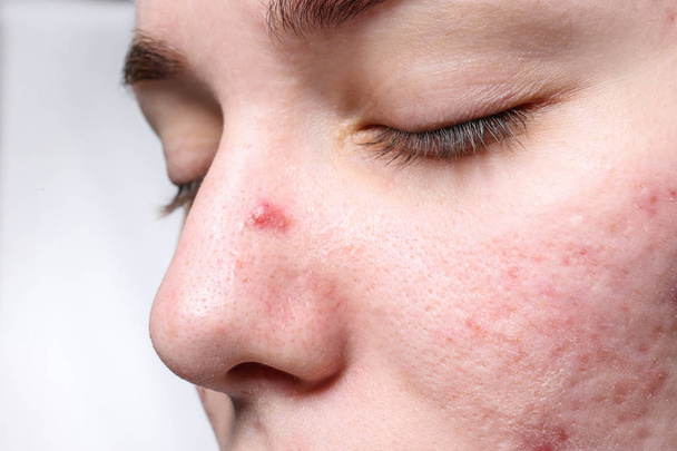 Young woman with acne on her face, closeup - 写真・画像