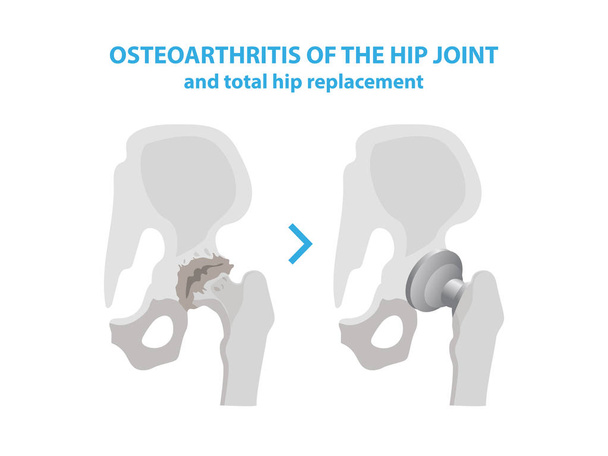 Osteoarthritis of the Hip Joint and Hip Replacement Surgery medical infographic elements isolated on white background. Joint with arthritis and replaces it with an artificial joint made from metal. - Vector, Image