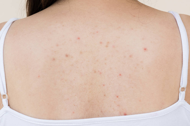 Gezondheidsprobleem, close-up jong meisje acne op haar rug. - Foto, afbeelding