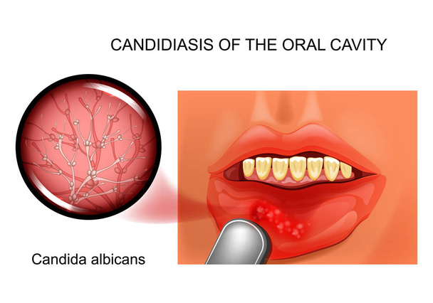 Векторні ілюстрації перорального кандидозу. причинно-наслідковий агент Candida albicans
 - Вектор, зображення