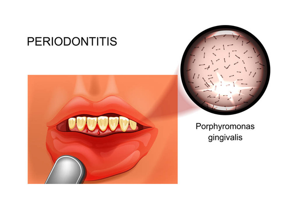 vector illustration of periodontitis. bleeding gums. stomatology - Vector, Image