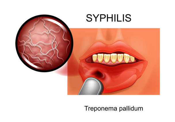 vector illustration of syphilis. chancre. Treponema pallidum - Vector, Image