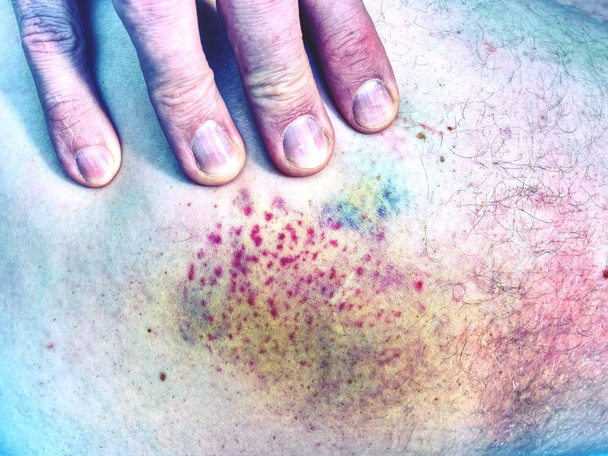 白い肌の上に新鮮な痣。痛みを伴う緑紫巨大なあざを男性の足に。人間の皮膚に皮下損傷 - 写真・画像